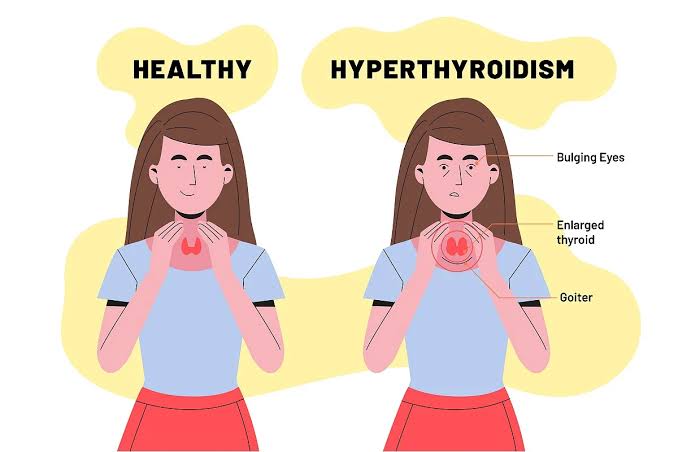 Thyroid: थायराइड होने पर शरीर में दिखते हैं ये लक्षण, न करें नजरअंदाज