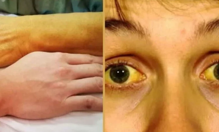 Chhattisgarh News: छत्तीसगढ़ के इस जिले में पीलिया का प्रकोप… 30 से ज्यादा लोग आए चपेट में, दो की हालत गंभीर